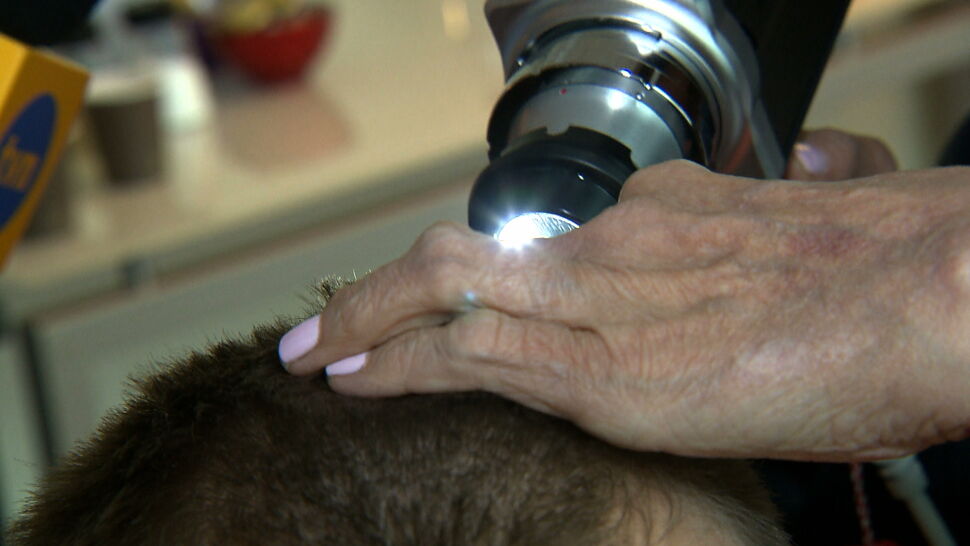 Trichoskopia ratunkiem dla włosów. Ta metoda może zahamować łysienie